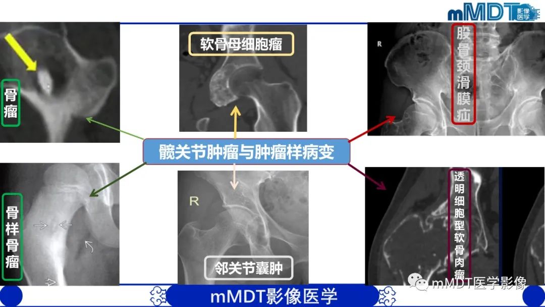 影像PPT - 【PPT】髋关节疼痛影像与临床(二)-45 影像PPT - 【PPT】髋关节疼痛影像与临床(二)-45