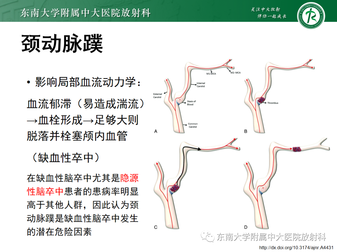 影像PPT - 【PPT】颈动脉蹼-6