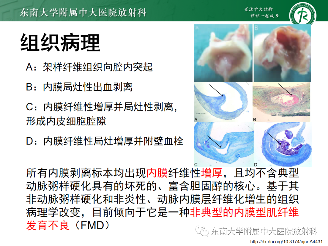 影像PPT - 【PPT】颈动脉蹼-9
