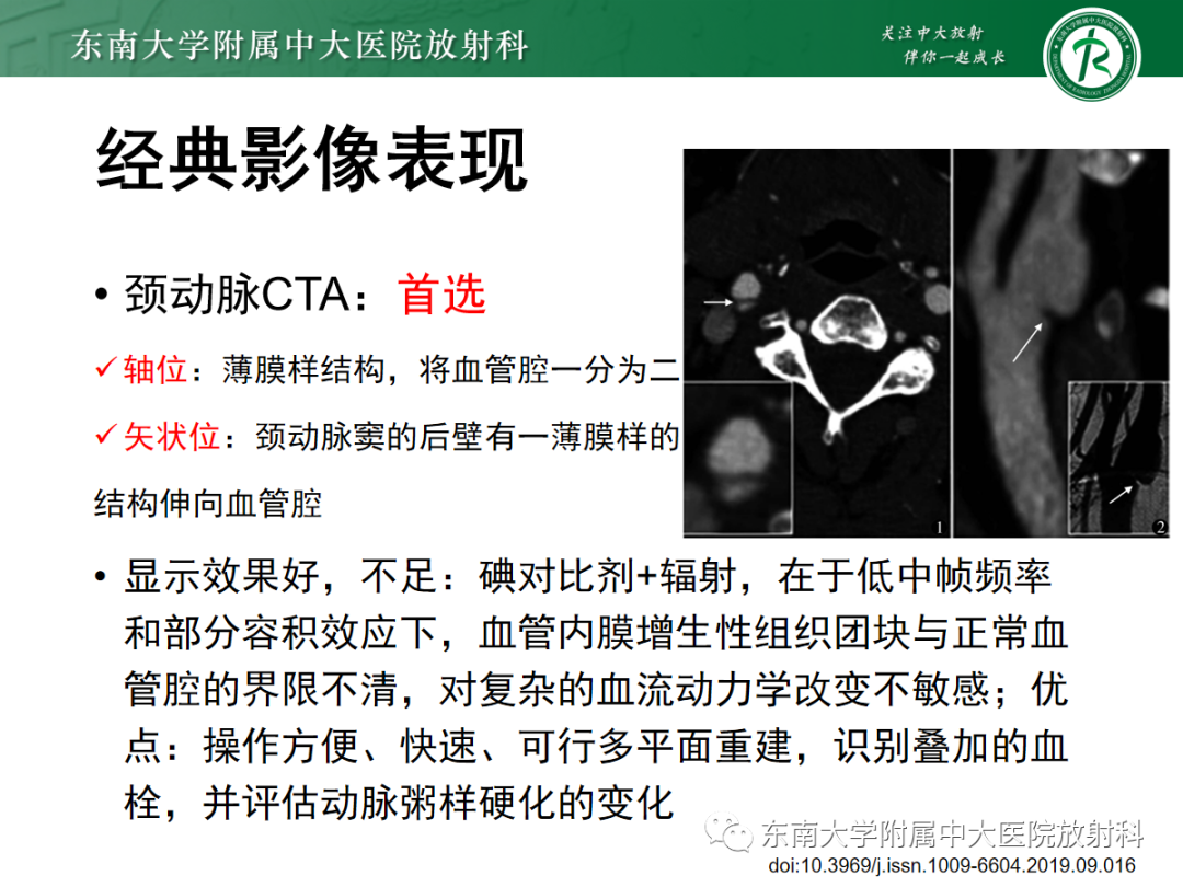 影像PPT - 【PPT】颈动脉蹼-11