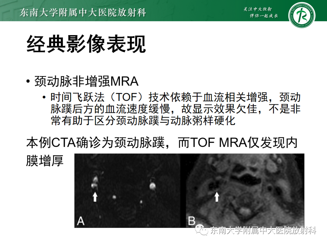 影像PPT - 【PPT】颈动脉蹼-13