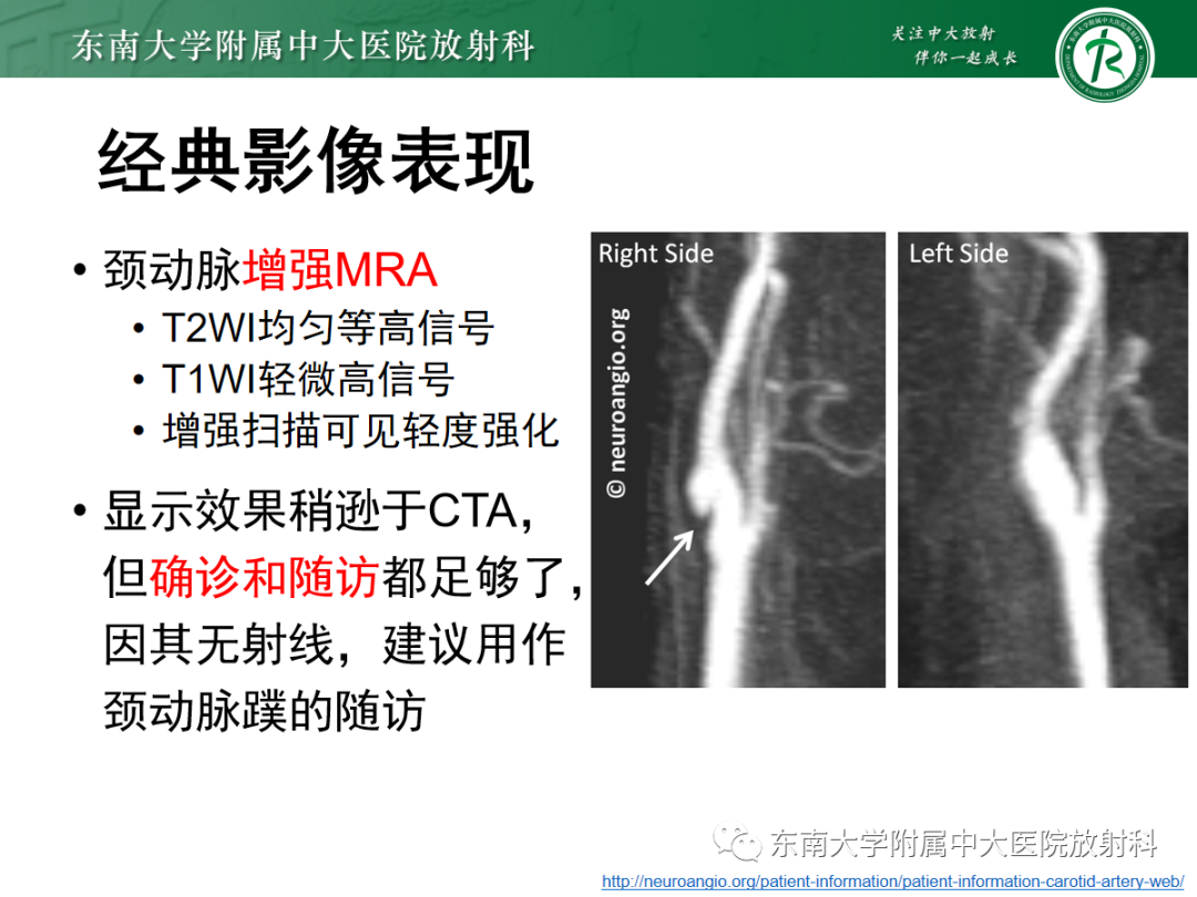 影像PPT - 【PPT】颈动脉蹼-14