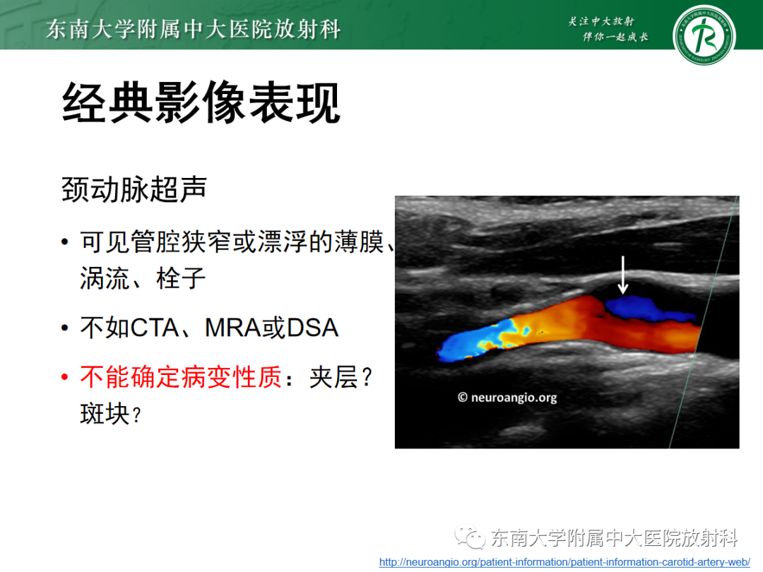 影像PPT - 【PPT】颈动脉蹼-12