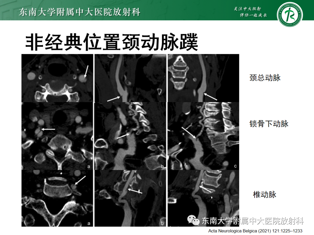 影像PPT - 【PPT】颈动脉蹼-16