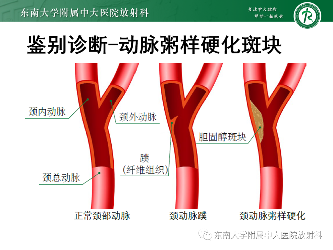 影像PPT - 【PPT】颈动脉蹼-20