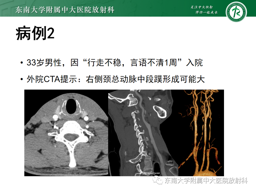 影像PPT - 【PPT】颈动脉蹼-18
