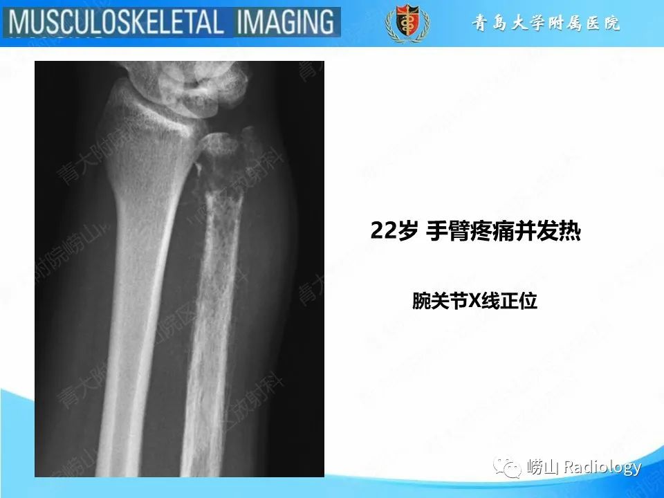影像PPT - 【PPT】尤文肉瘤-2