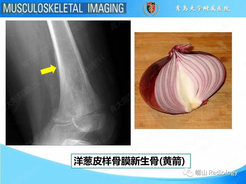 影像PPT - 【PPT】尤文肉瘤-8