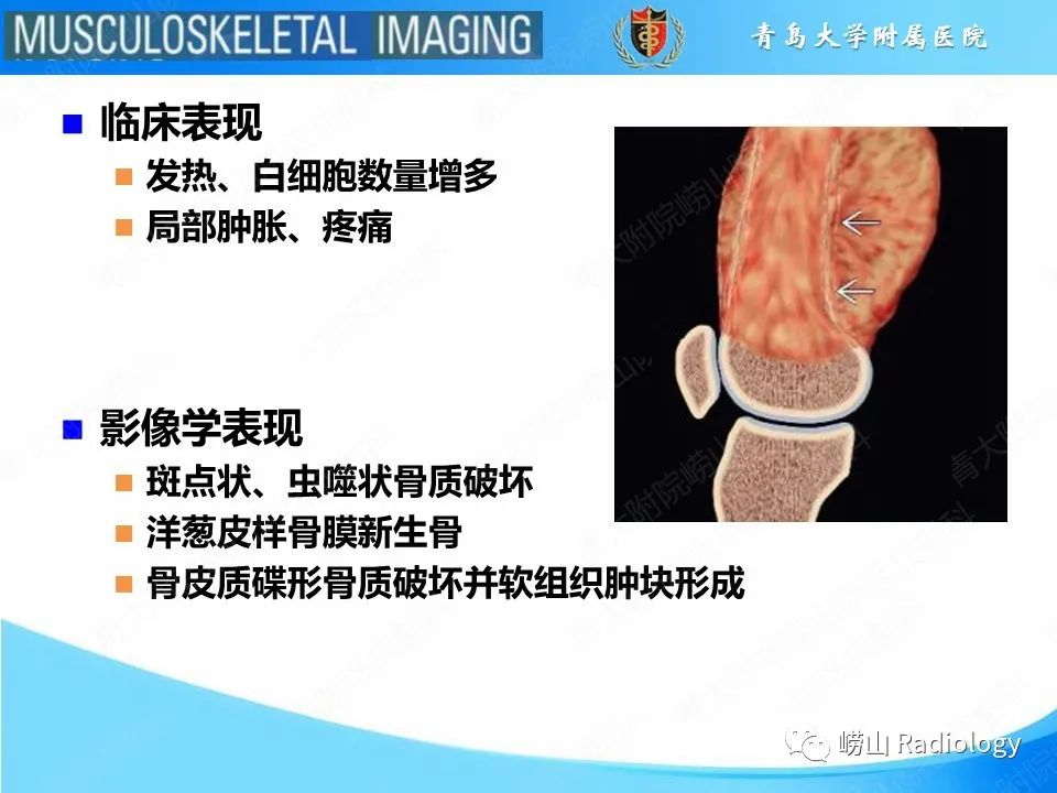 影像PPT - 【PPT】尤文肉瘤-7