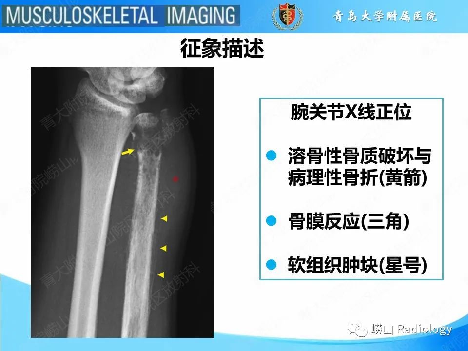 影像PPT - 【PPT】尤文肉瘤-15