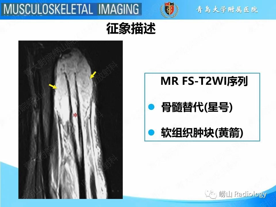 影像PPT - 【PPT】尤文肉瘤-16