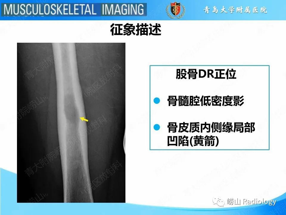 影像PPT - 【PPT】尤文肉瘤-17