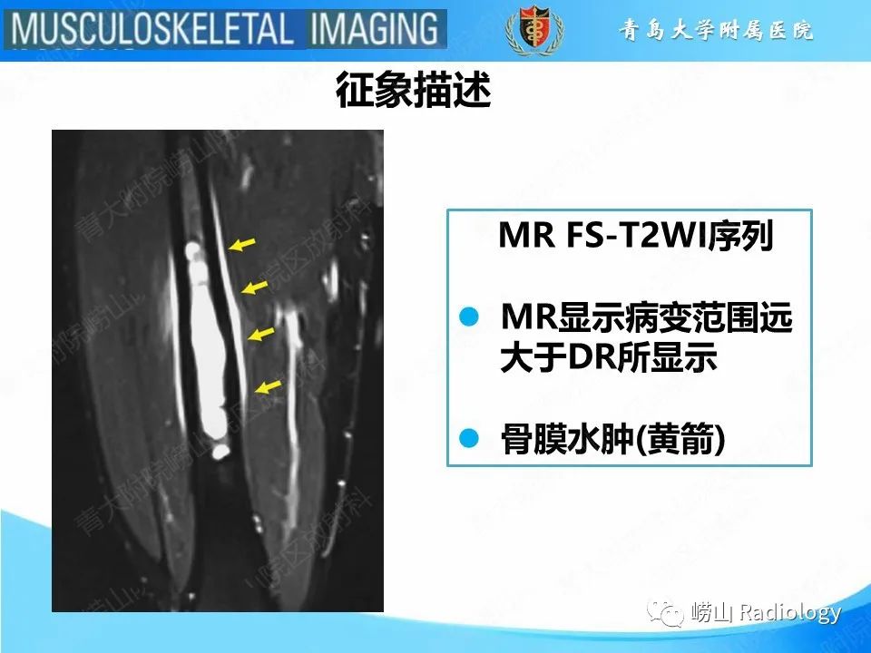 影像PPT - 【PPT】尤文肉瘤-18