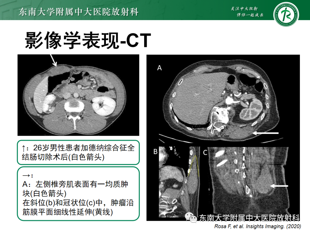影像PPT - 【PPT】腹壁韧带样纤维瘤病-11
