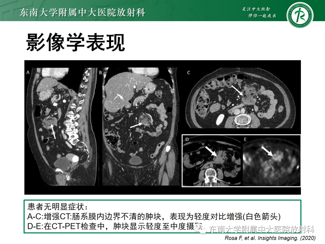 影像PPT - 【PPT】腹壁韧带样纤维瘤病-16