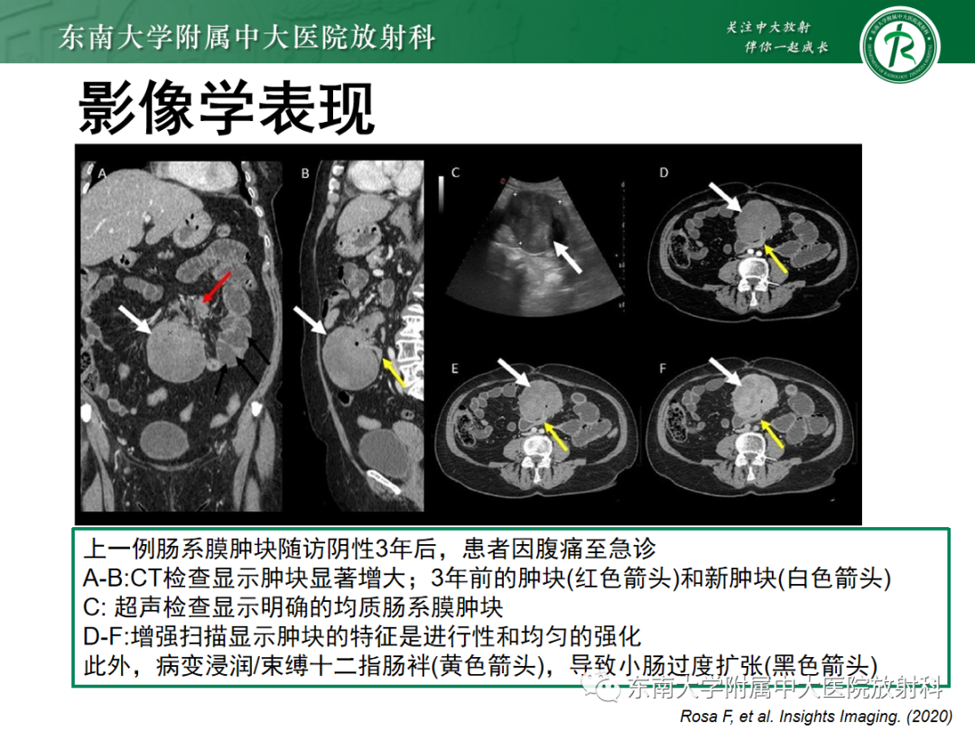 影像PPT - 【PPT】腹壁韧带样纤维瘤病-17