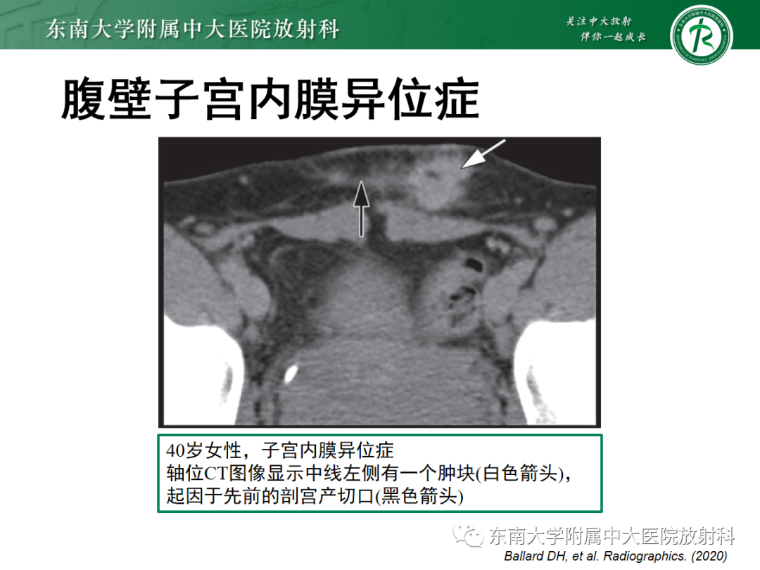 影像PPT - 【PPT】腹壁韧带样纤维瘤病-22