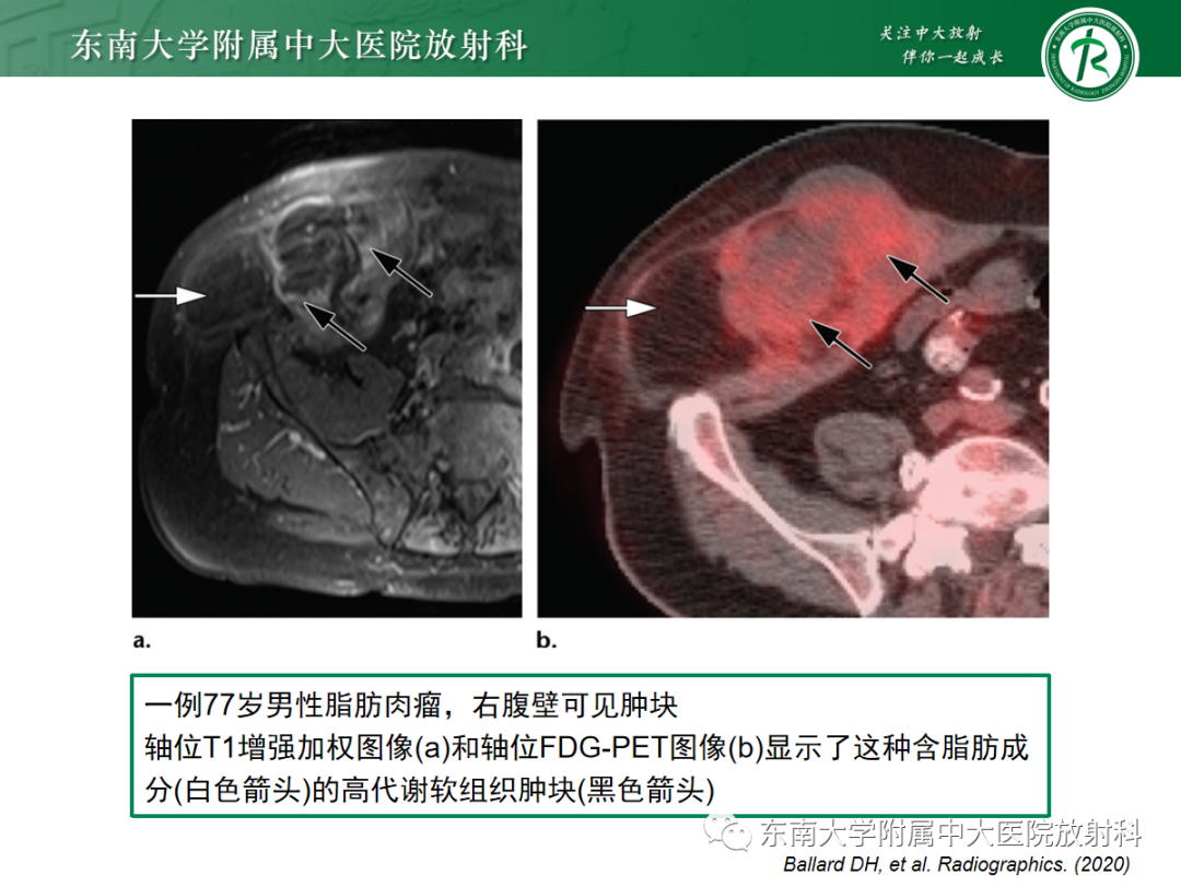 影像PPT - 【PPT】腹壁韧带样纤维瘤病-25