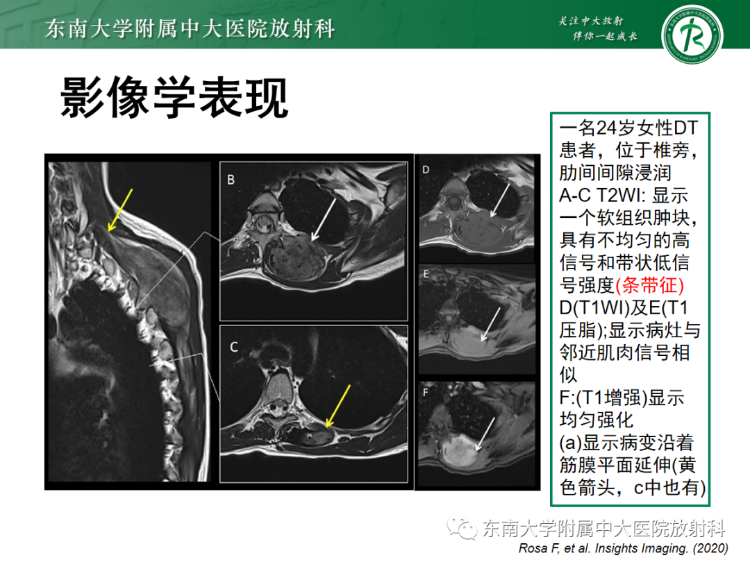 影像PPT - 【PPT】腹壁韧带样纤维瘤病-10