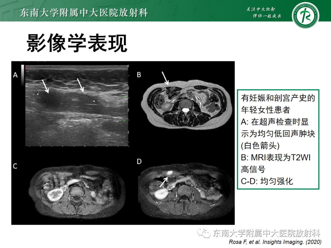 影像PPT - 【PPT】腹壁韧带样纤维瘤病-11