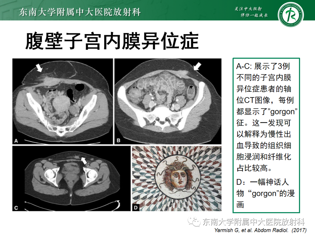 影像PPT - 【PPT】腹壁韧带样纤维瘤病-13