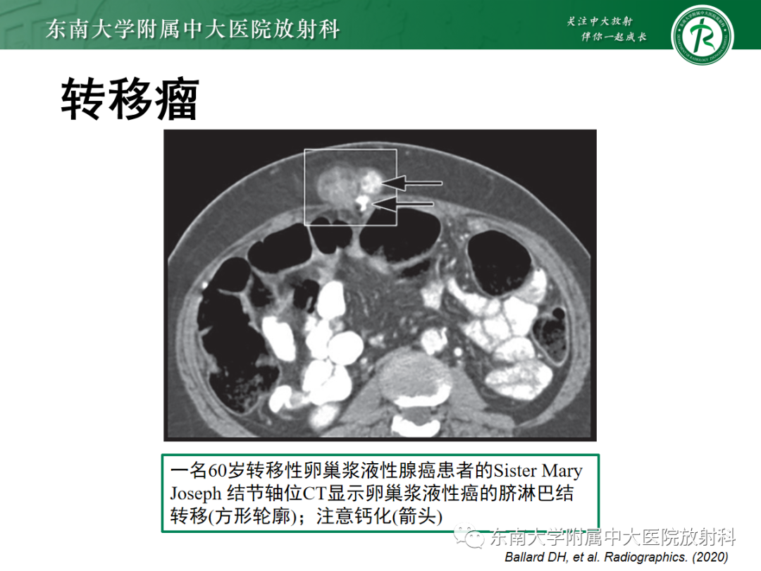 影像PPT - 【PPT】腹壁韧带样纤维瘤病-15