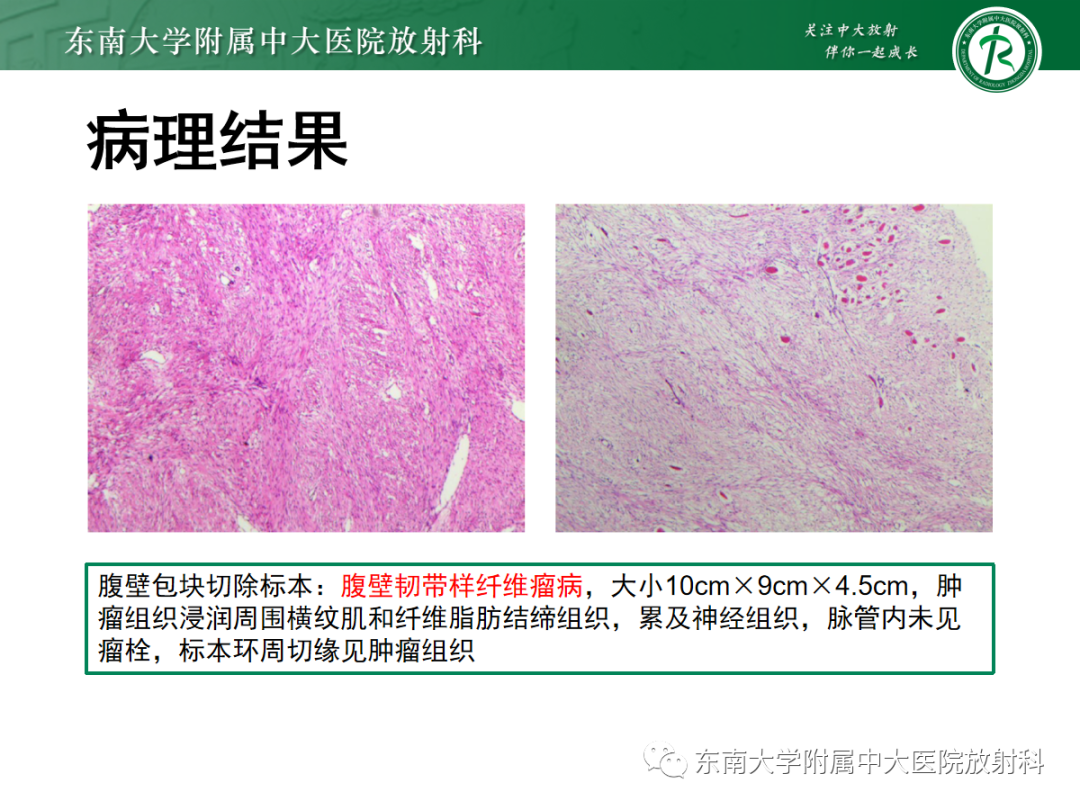 影像PPT - 【PPT】腹壁韧带样纤维瘤病-2