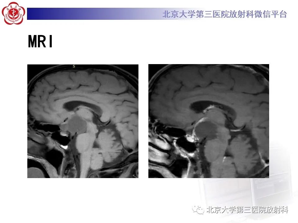 影像PPT - 【PPT】鞍区、鞍旁肿瘤-4