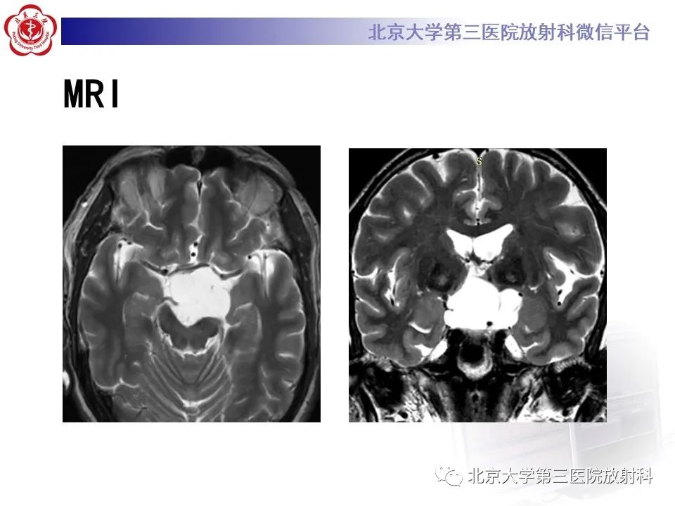影像PPT - 【PPT】鞍区、鞍旁肿瘤-3