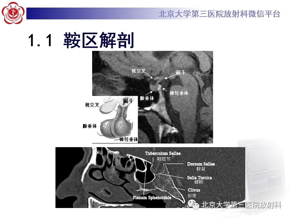 影像PPT - 【PPT】鞍区、鞍旁肿瘤-8
