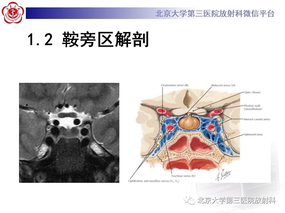 影像PPT - 【PPT】鞍区、鞍旁肿瘤-9