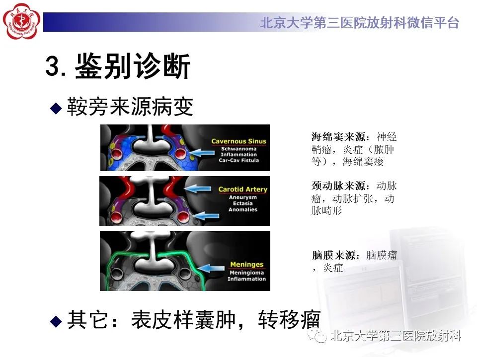影像PPT - 【PPT】鞍区、鞍旁肿瘤-11