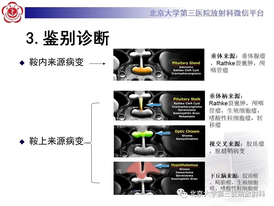影像PPT - 【PPT】鞍区、鞍旁肿瘤-10