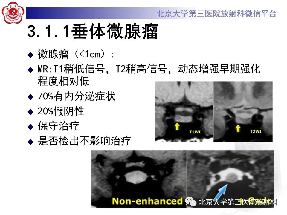 影像PPT - 【PPT】鞍区、鞍旁肿瘤-13