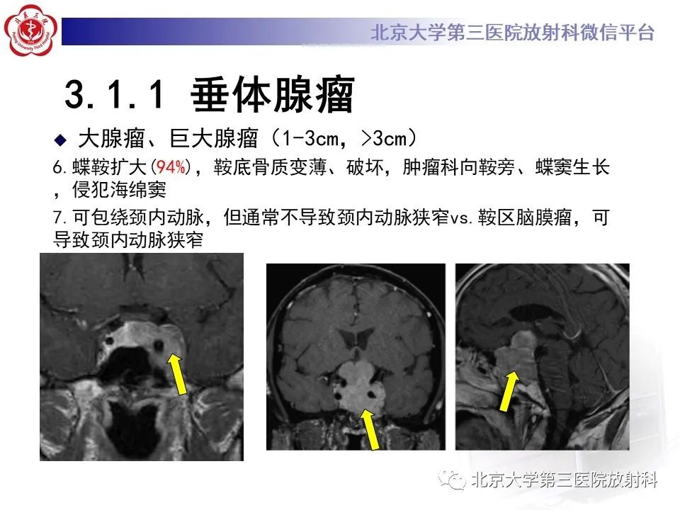 影像PPT - 【PPT】鞍区、鞍旁肿瘤-15