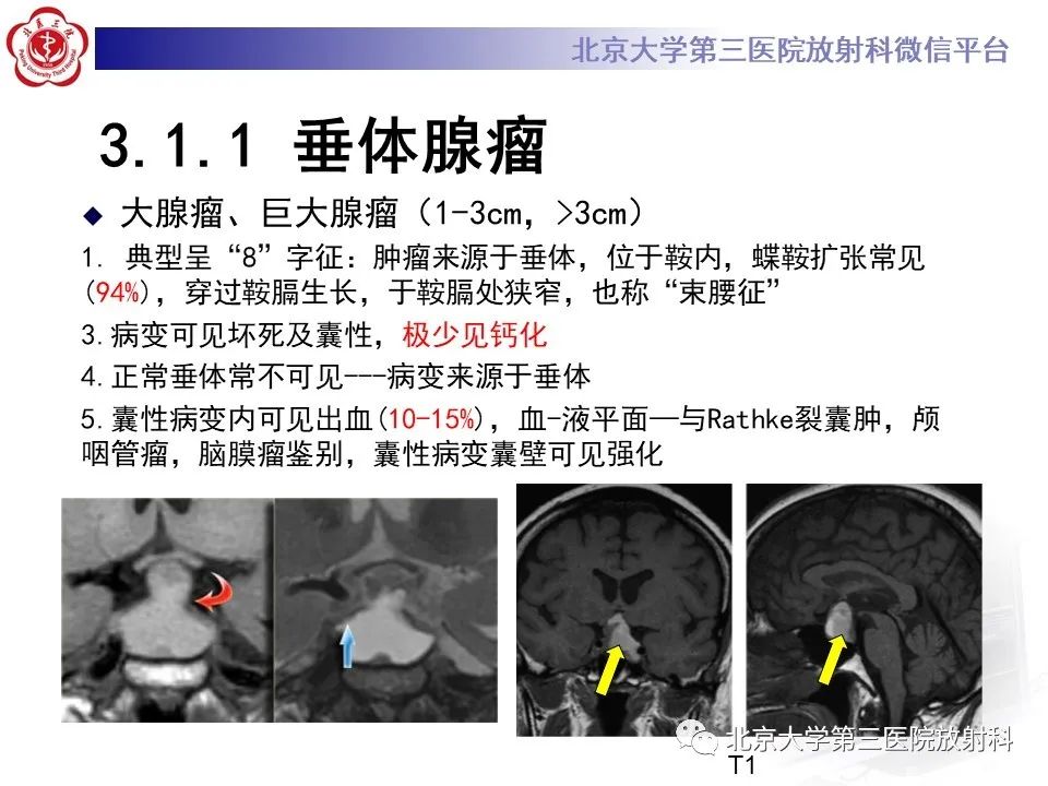 影像PPT - 【PPT】鞍区、鞍旁肿瘤-14