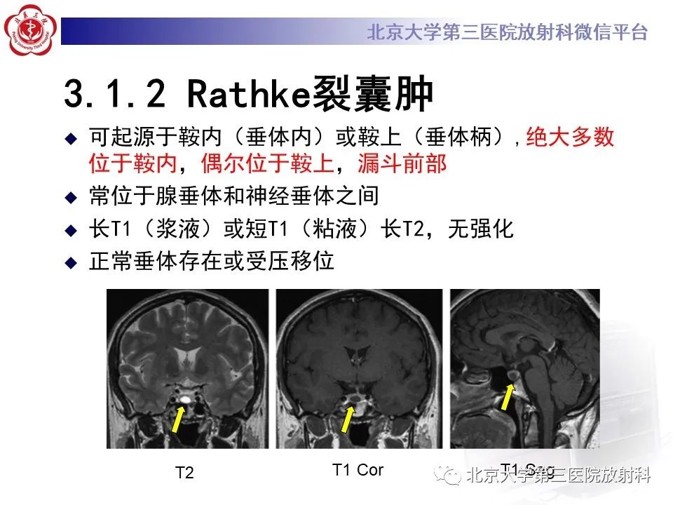 影像PPT - 【PPT】鞍区、鞍旁肿瘤-16