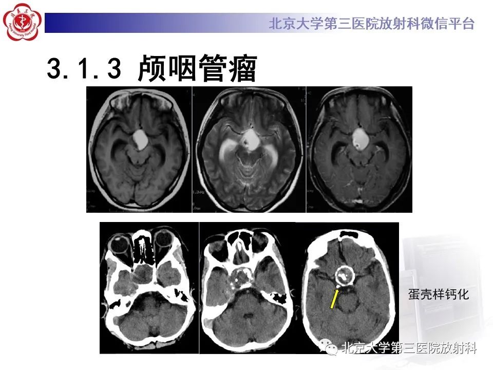 影像PPT - 【PPT】鞍区、鞍旁肿瘤-18