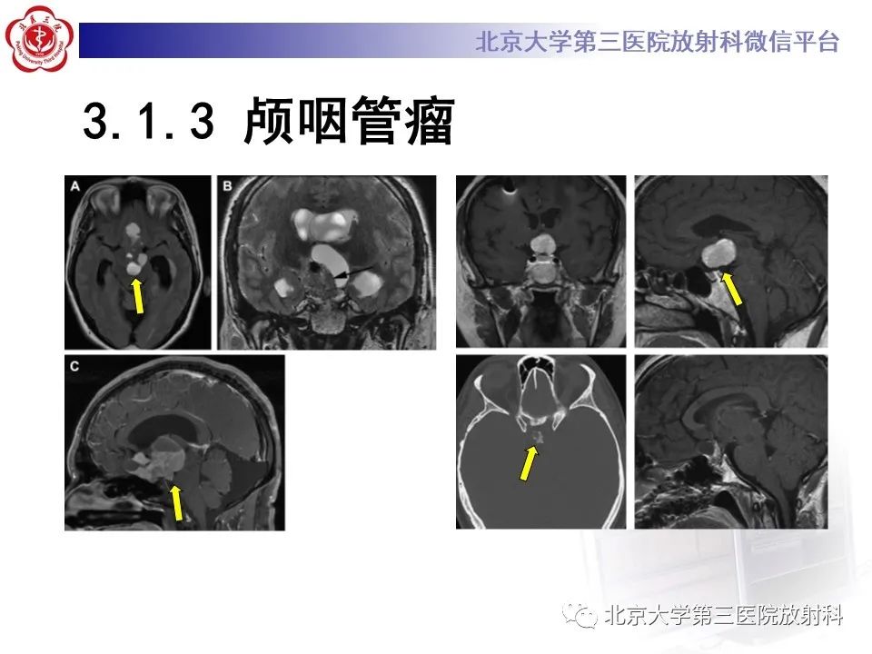 影像PPT - 【PPT】鞍区、鞍旁肿瘤-19