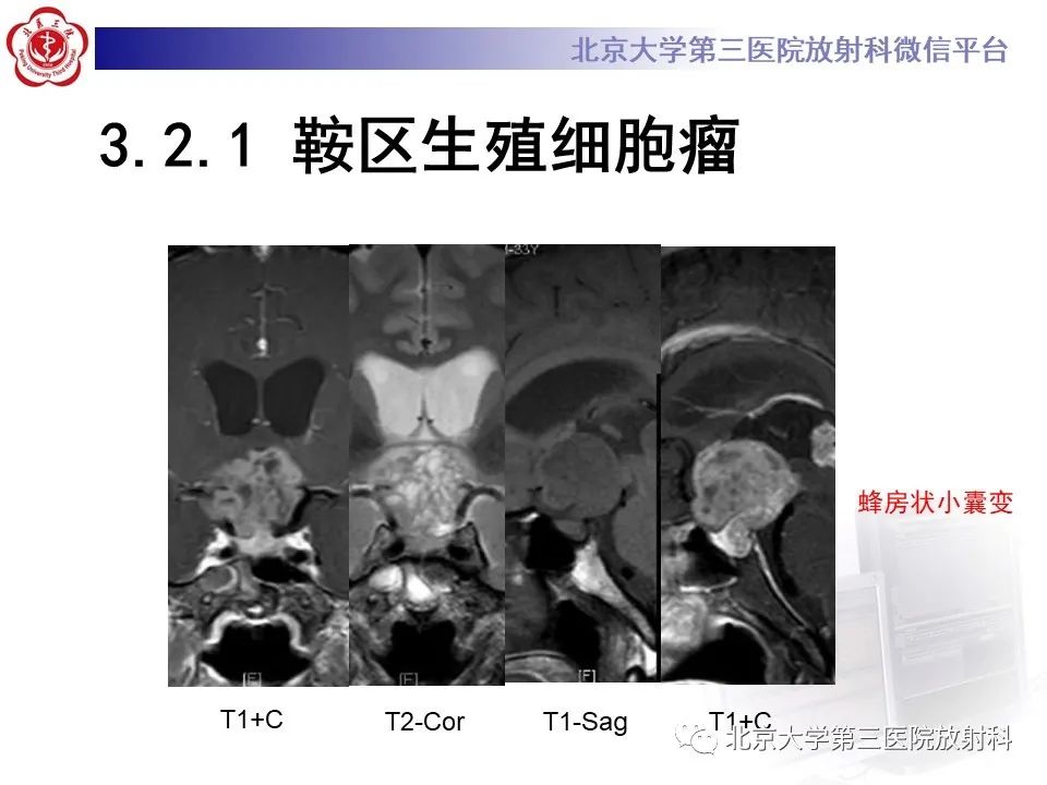 影像PPT - 【PPT】鞍区、鞍旁肿瘤-22