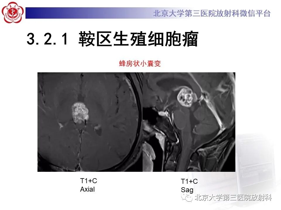 影像PPT - 【PPT】鞍区、鞍旁肿瘤-23