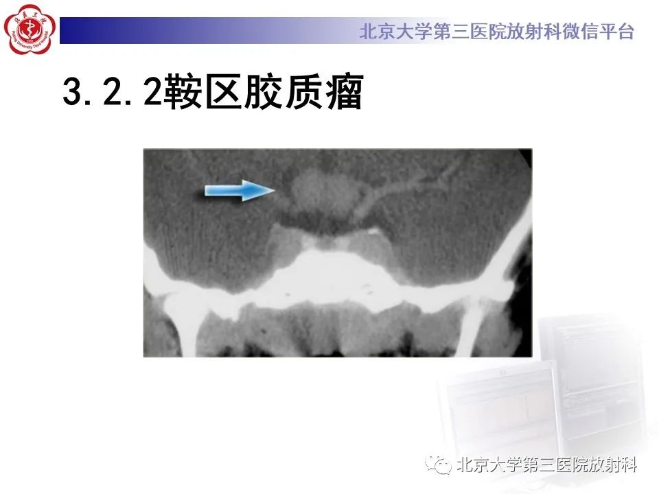 影像PPT - 【PPT】鞍区、鞍旁肿瘤-25
