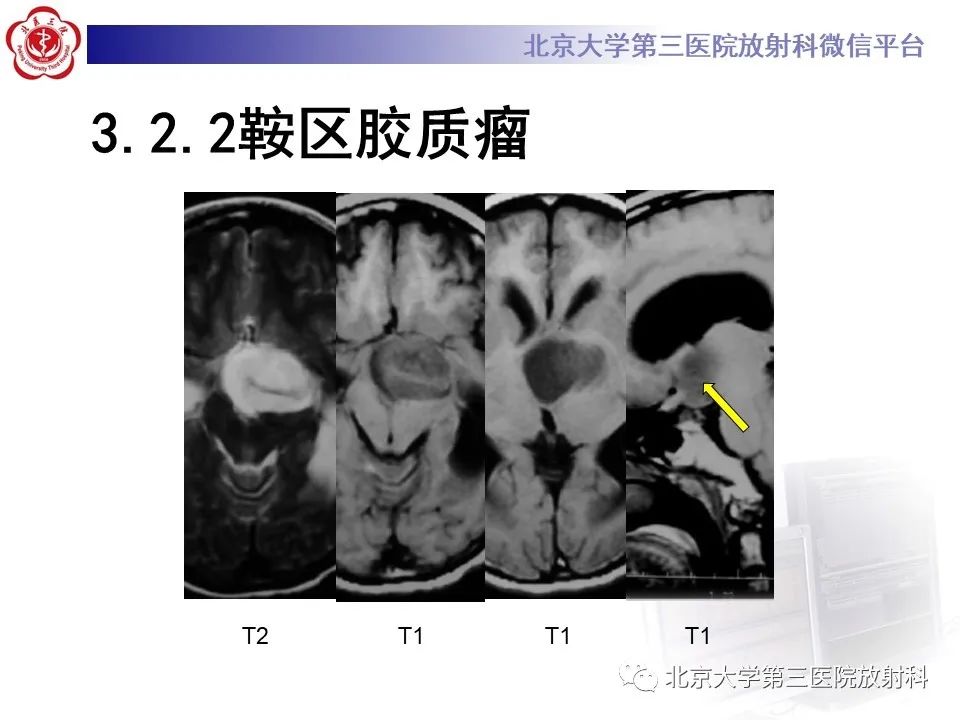 影像PPT - 【PPT】鞍区、鞍旁肿瘤-26