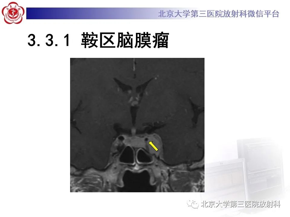 影像PPT - 【PPT】鞍区、鞍旁肿瘤-31