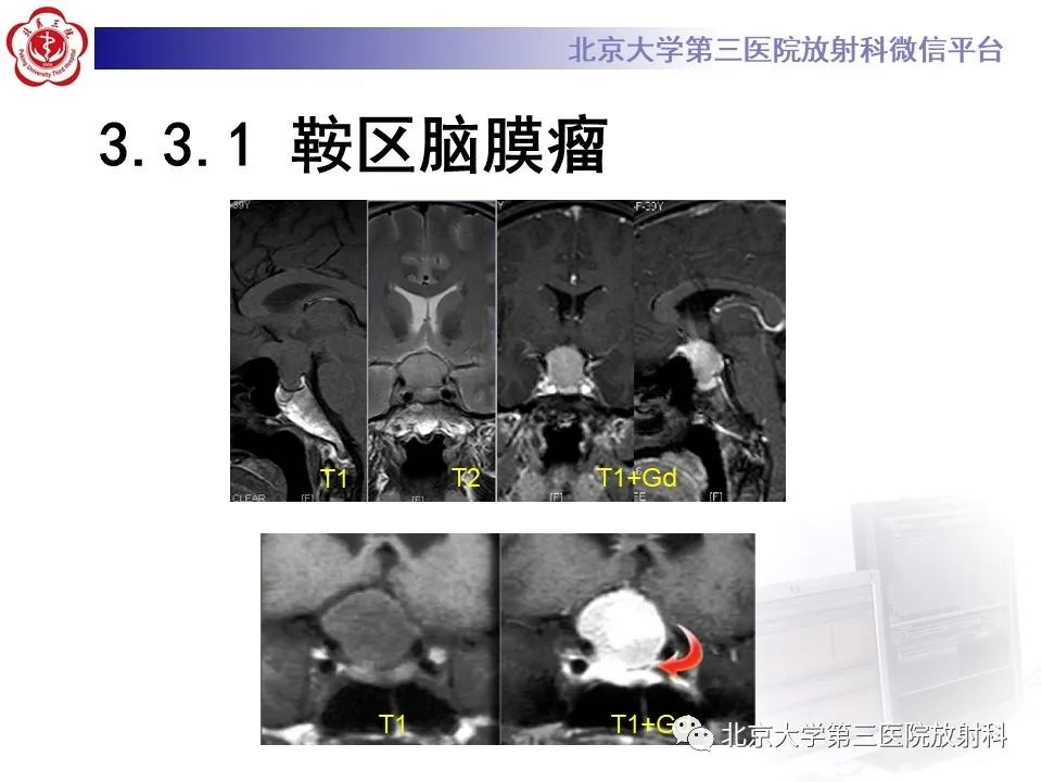 影像PPT - 【PPT】鞍区、鞍旁肿瘤-30