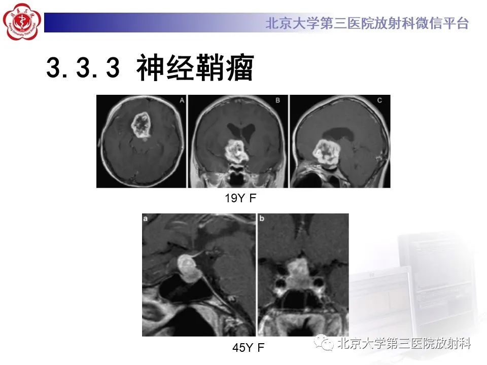 影像PPT - 【PPT】鞍区、鞍旁肿瘤-34