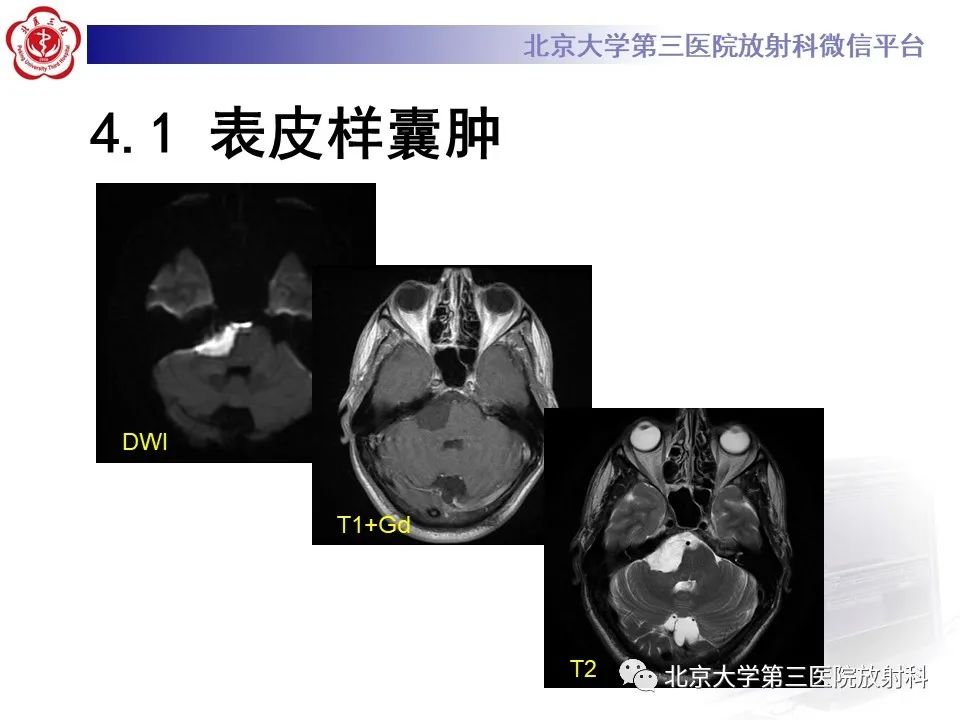 影像PPT - 【PPT】鞍区、鞍旁肿瘤-36