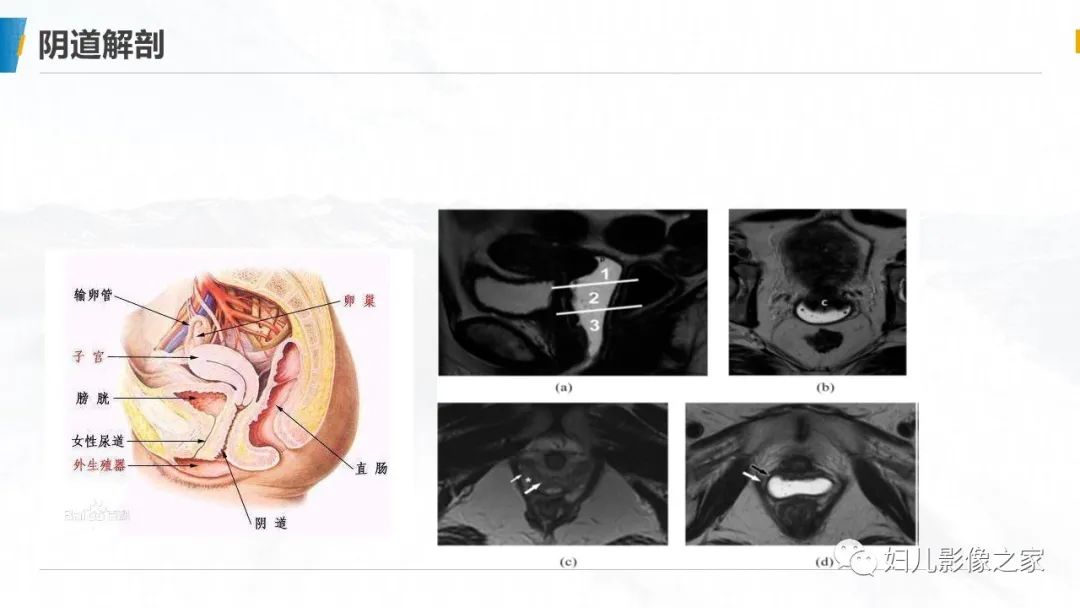 影像PPT - 【PPT】阴道积血3例诊断及鉴别诊断-15