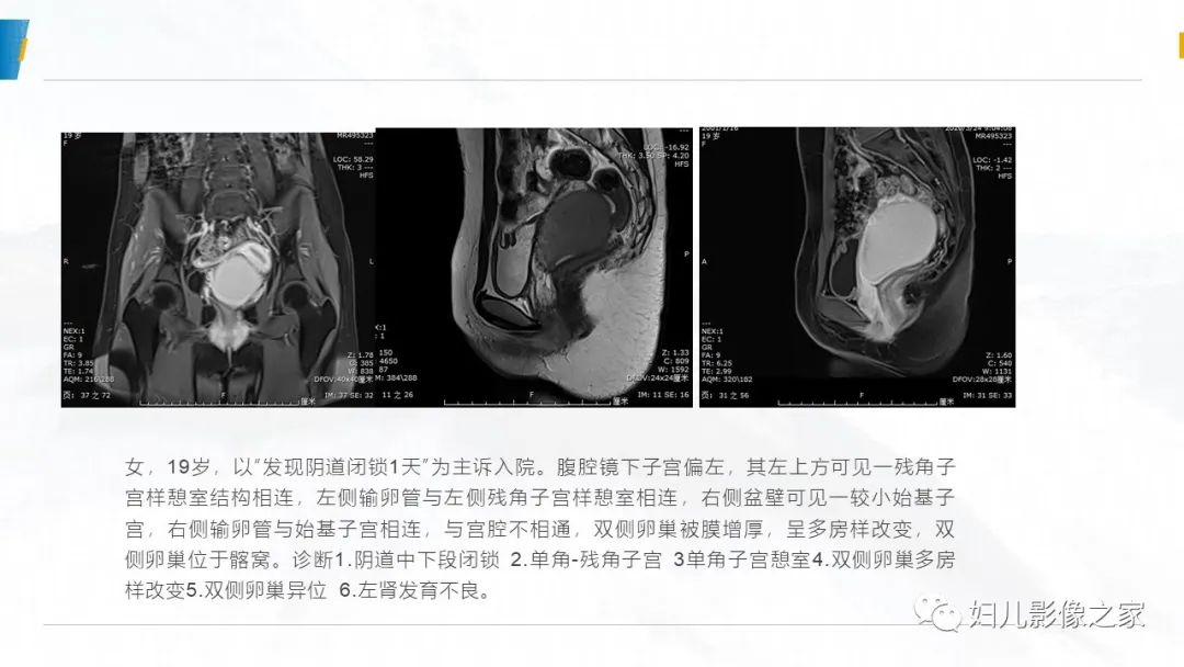 影像PPT - 【PPT】阴道积血3例诊断及鉴别诊断-22
