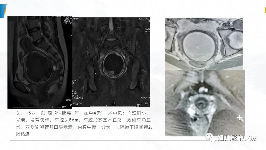 影像PPT - 【PPT】阴道积血3例诊断及鉴别诊断-21